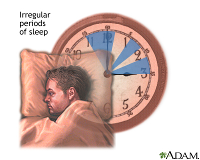 Irregular Sleep-Wake Rhythm